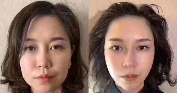 西班牙帝美妮面部提升王 西班牙帝美妮面部提升王